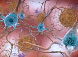 In patients with Alzheimer's disease, tau proteins (shown in light blue) misfold and accumulate inside brain cells. By making a synthetic version of these proteins, researchers aim to better understand disease. Image by the National Institute on Aging